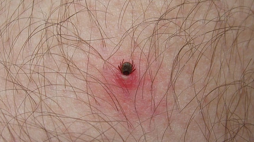 1024px-Tick lodged in human host