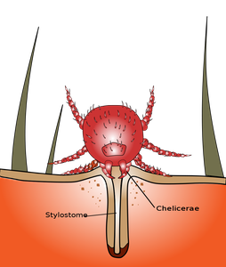 Chigger_bite_1000px