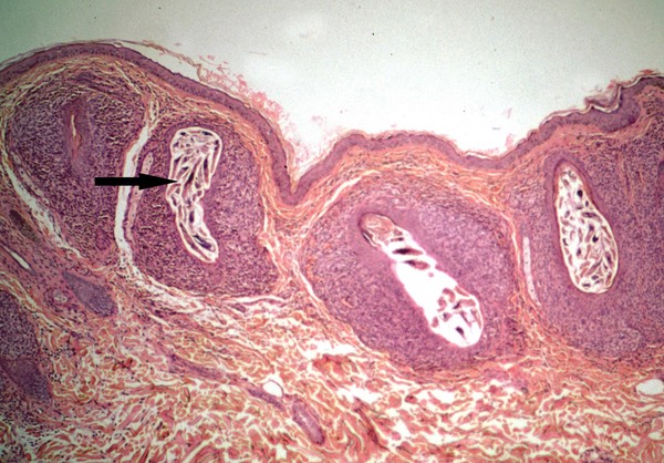 Demodex-in-follicle