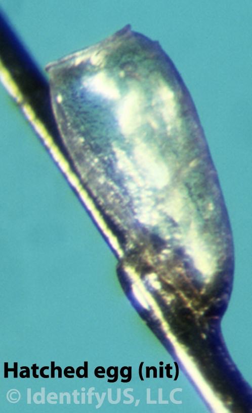 head louse hatched egg