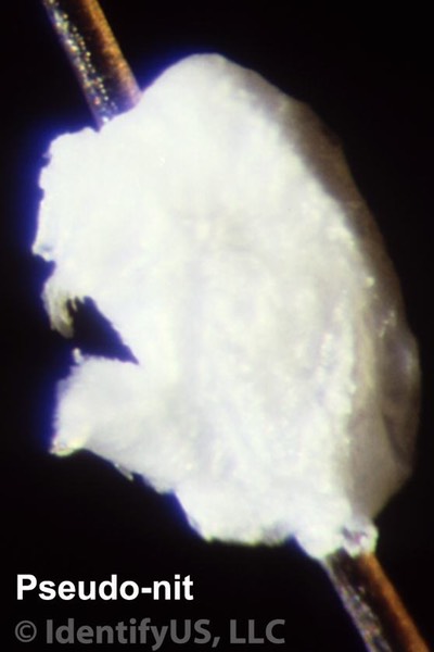 Head louse - pseudo nit